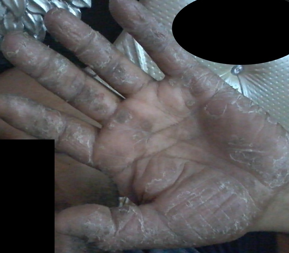 "Palmer Psoriasis"   Before Treatment Left Hand