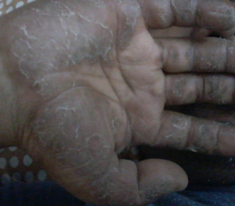 "Palmer Psoriasis"   Before Treatment Right Hand