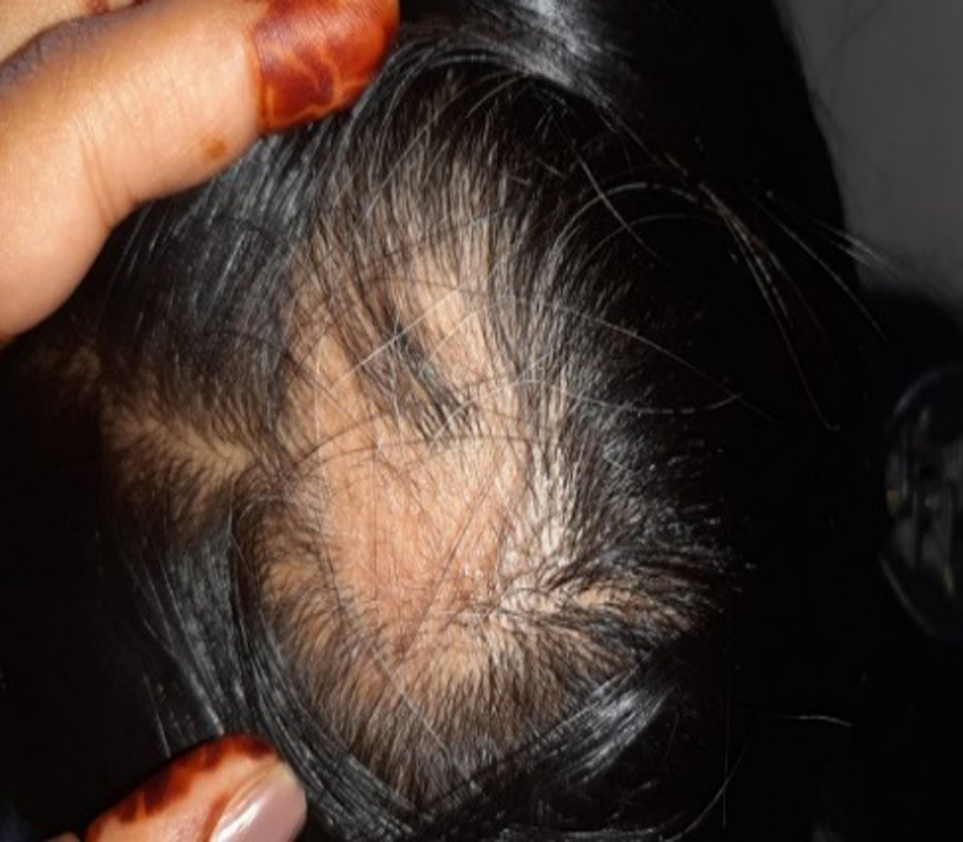 "Alopecia Arata or Indralupta"   Before Treatment