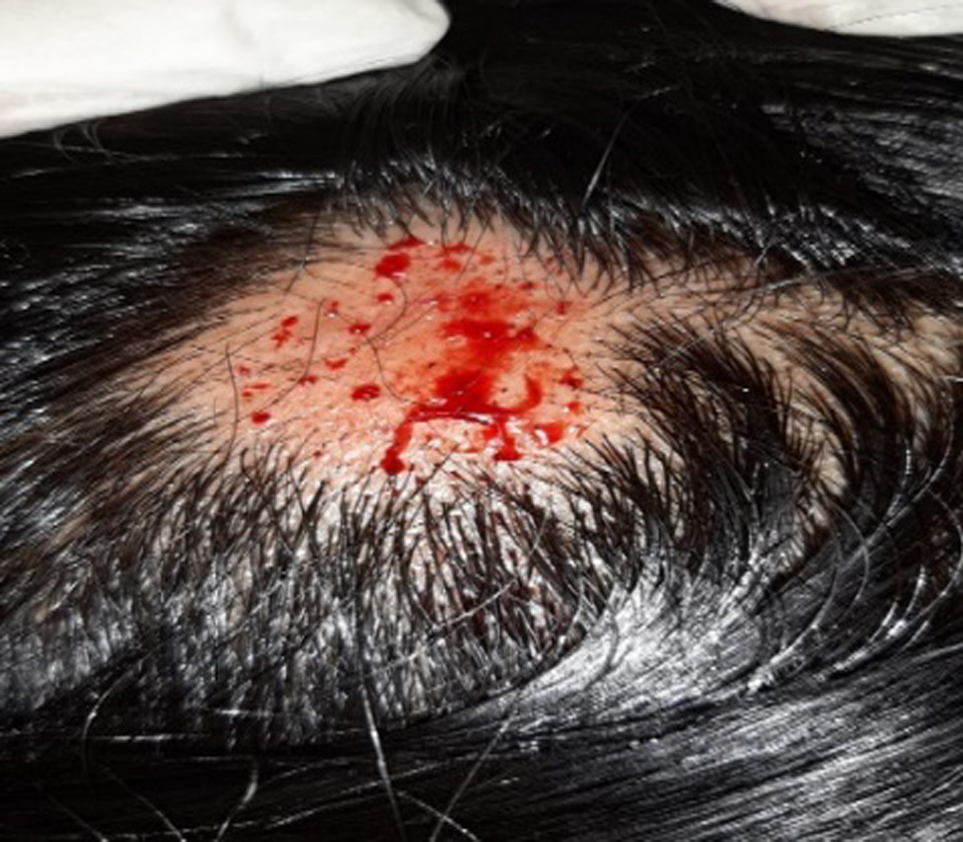 "Alopecia Arata or Indralupta"   After Prachhan Karma