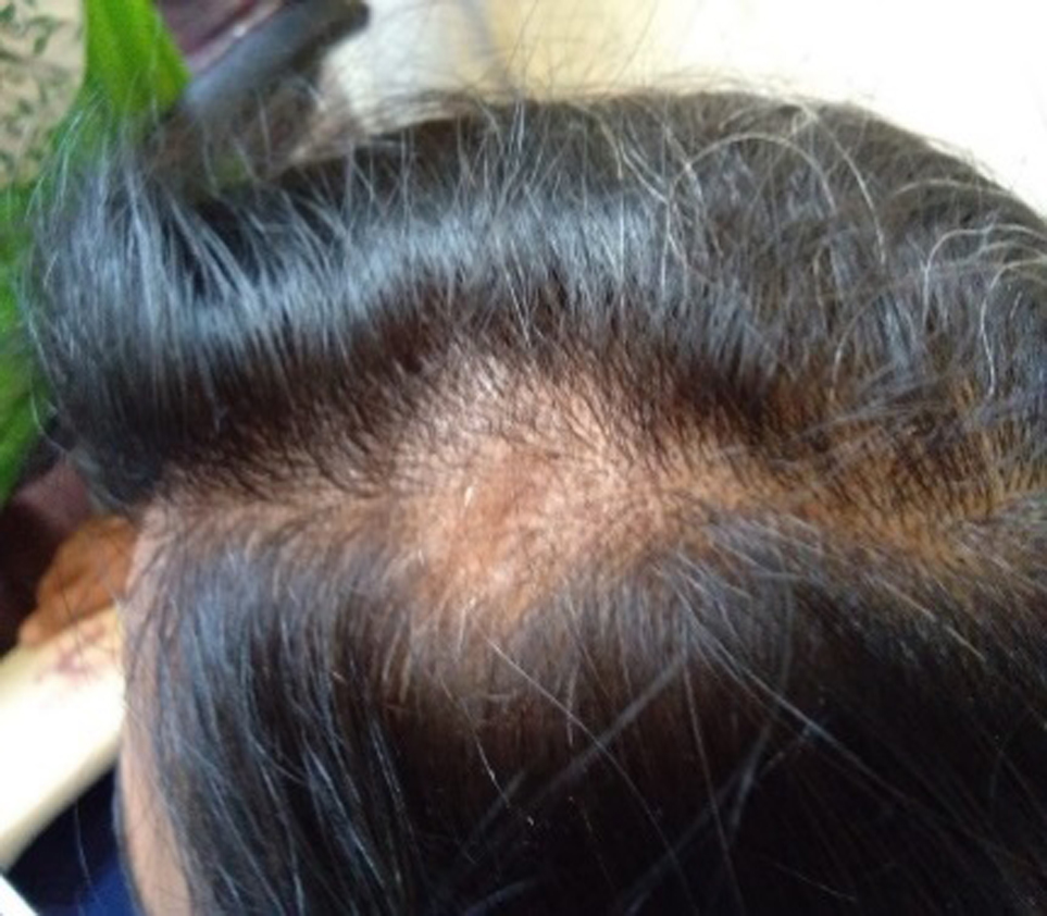 "Alopecia Arata or Indralupta"   After Treatment